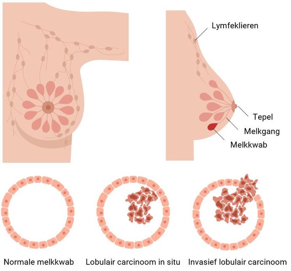 Lobulair carcinoom (borstcentrum).jpg