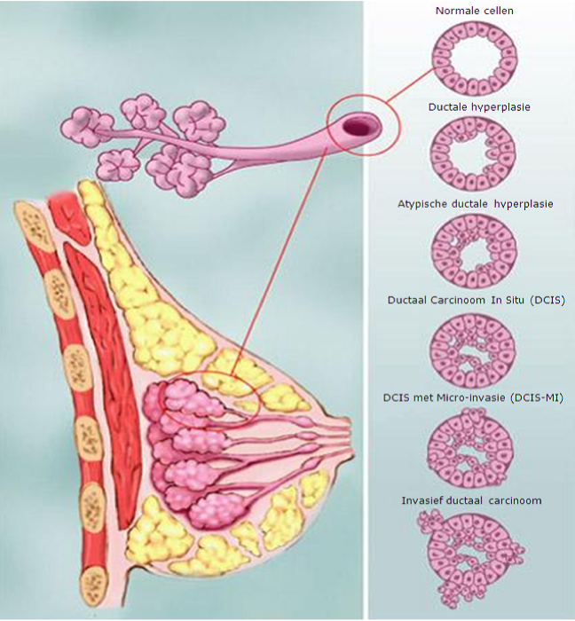 Ductaal carcinoom (borstcentrum).png